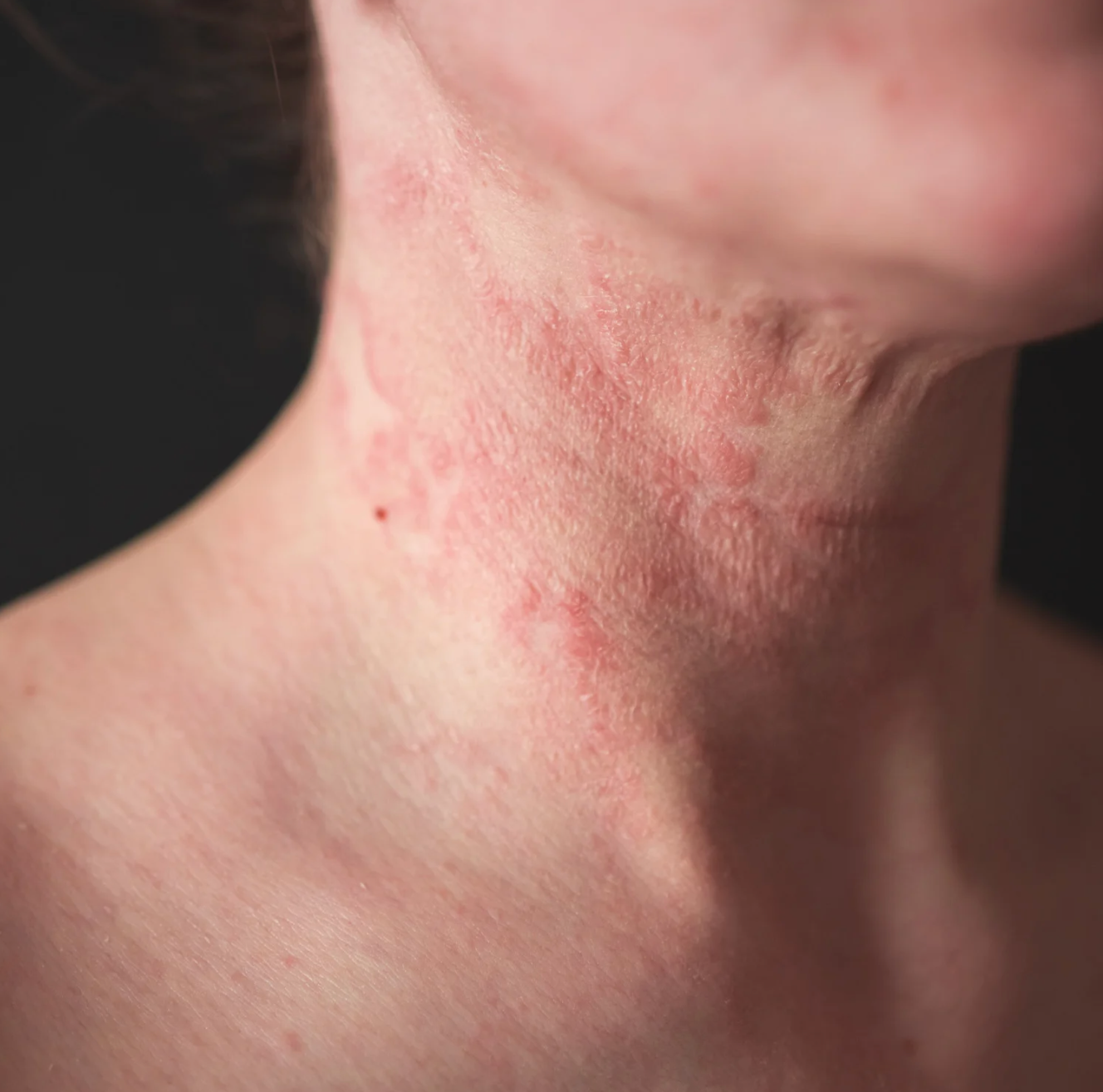 Jak stosować terapię światłem czerwonym w leczeniu egzemy w domu w 2025 roku